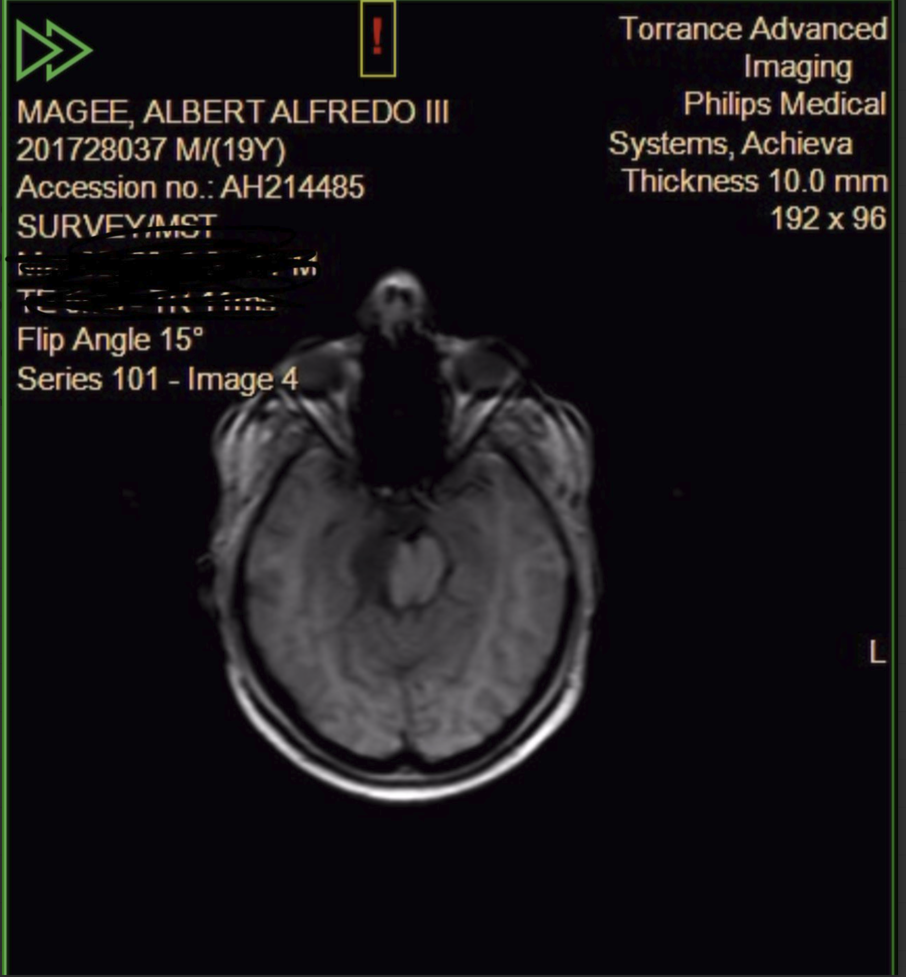 Brain MRI scan - before