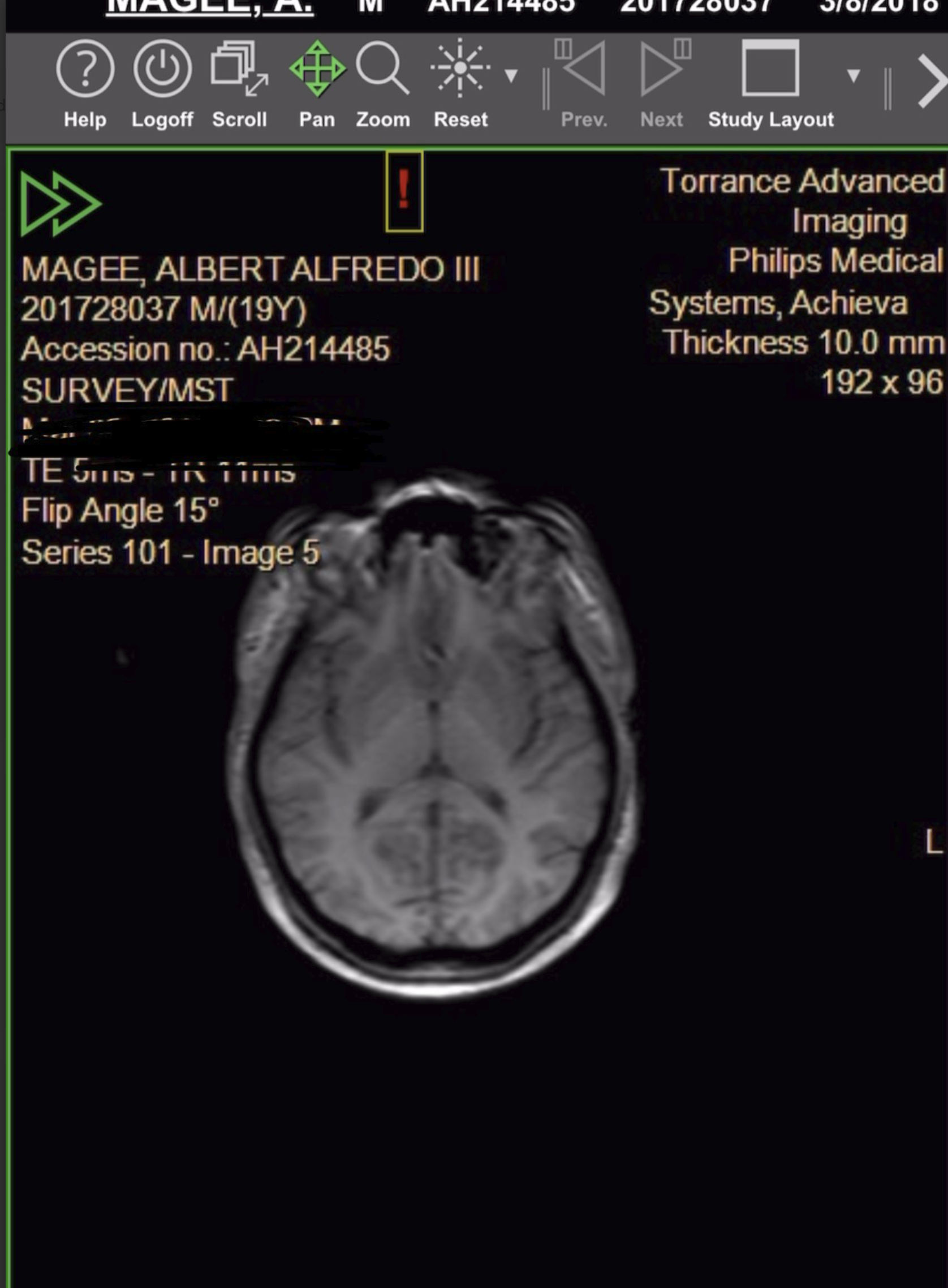 Brain MRI scan - after